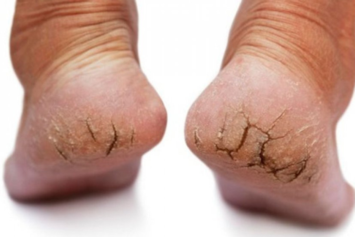 Dicas para Pés Rachados: Como Cuidar e Restaurar a Maciez - Oliveira Global
